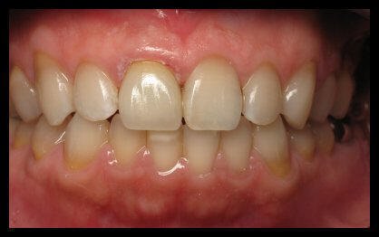 Dental Crowns & Bridges After