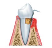Periodontal Scaling & Root Planing and gum disease treatment in Bellevue WA