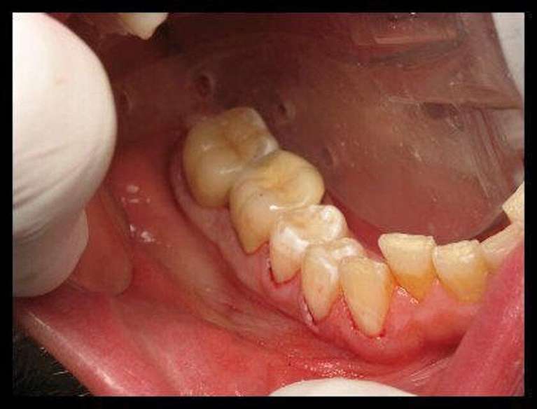 Composite-Fillings-After-Image