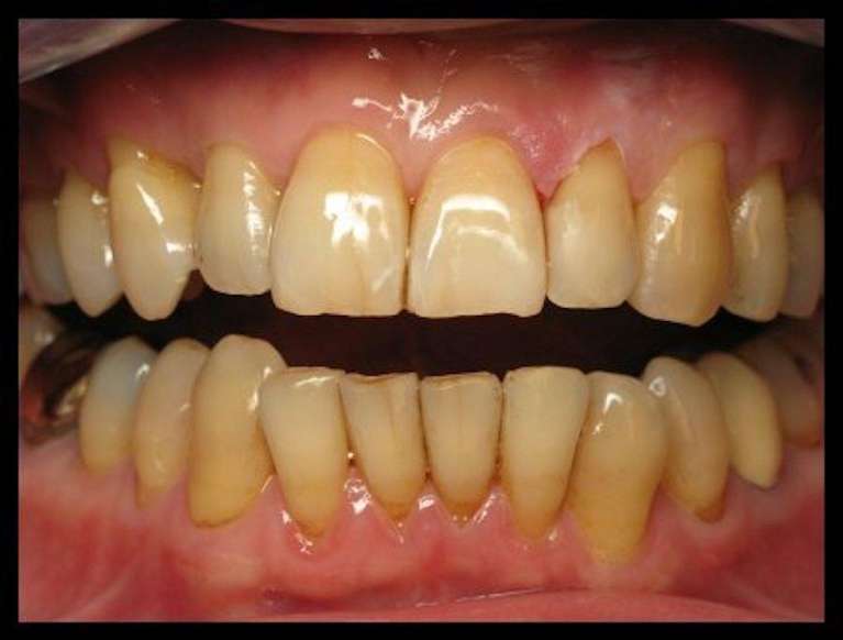 Composite-Fillings-After-Image