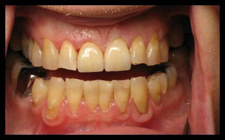 Crowns-and-Bridges-After-Image