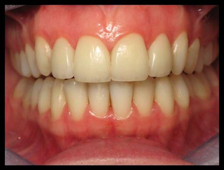 Porcelain-Veneers-After-Image
