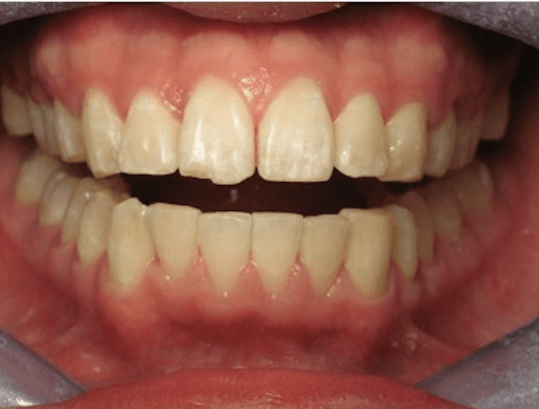 6-Month-Cosmetic-Braces-After-Image