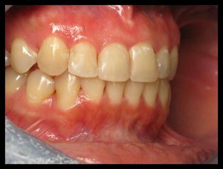 6-Month-Cosmetic-Braces-After-Image