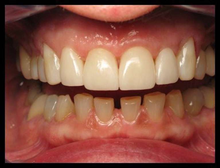Porcelain-Veneers-After-Image
