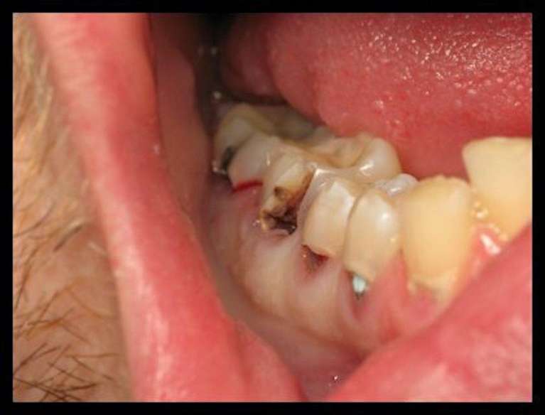Composite-Fillings-Before-Image