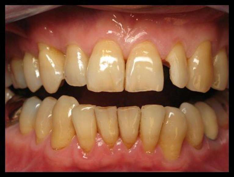 Composite-Fillings-Before-Image