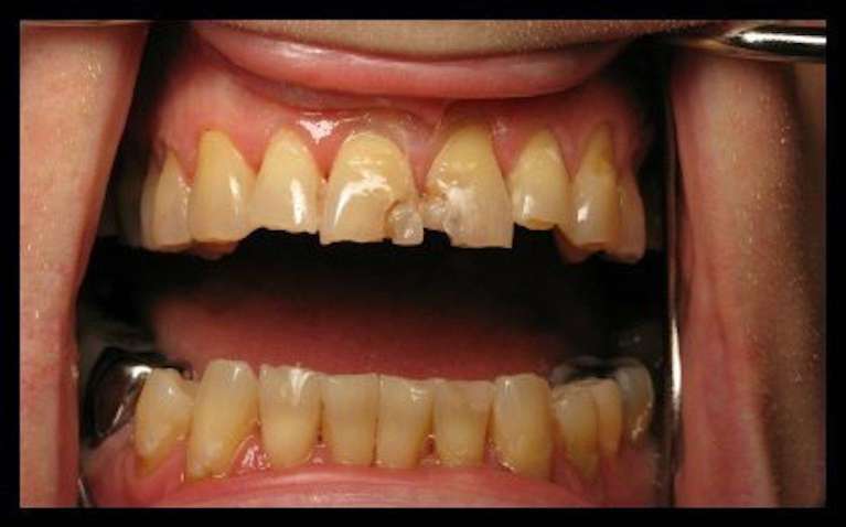 Crowns-and-Bridges-Before-Image