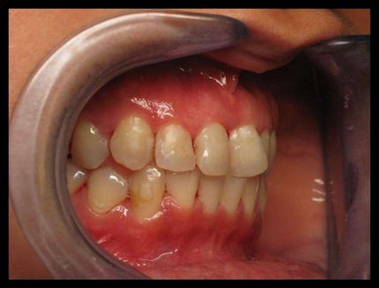 6-Month-Cosmetic-Braces-Before-Image