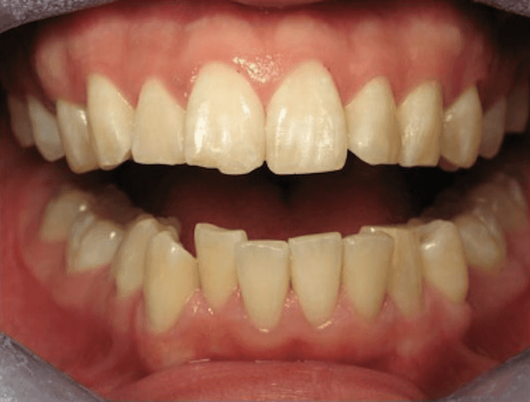 6-Month-Cosmetic-Braces-Before-Image