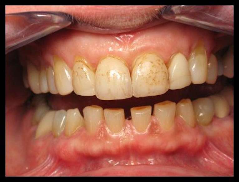 Porcelain-Veneers-Before-Image